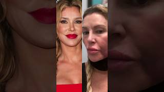 RHOBH Brandi Glanville SHOCKING Severe Face Swelling [upl. by Iznyl148]