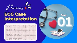 Abnormality in ECG Graph  Discussion about ECG Cases  ECG Cases for Students [upl. by Tj]