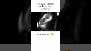 FETAL MOVEMENT😃 short youtubeshorts medical neet [upl. by Hescock]