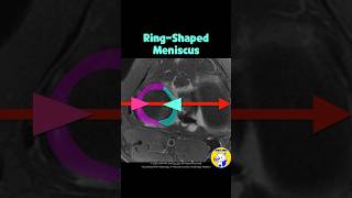 Fig 1C06 RingShaped Meniscus versus bucket handle tear [upl. by Keverne745]