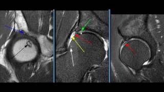 MRI Hip Case 19 [upl. by Jaquiss]