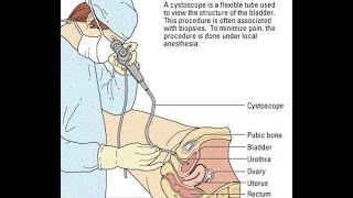 Video Cystoscopy Actual Procedure ENG SUB [upl. by Maje]