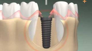 Zahnimplantation in 3D  Dental Implant 3D animation [upl. by Ailina]