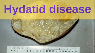 What is Hydatid Disease  Pathology mini tutorial [upl. by Hanako631]