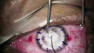 Femtosecond laser deep anterior lamellar keratoplasty [upl. by Ranee]