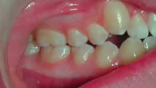 Invisalign Treatment Snaggle Tooth Correction [upl. by Schmitt]