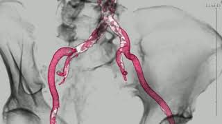 Severe aortoiliac calcification [upl. by Hsu]