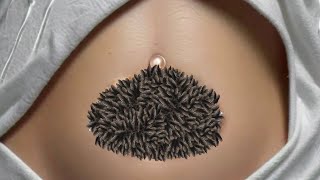 ASMR Button ✅ Treatment  ASMR Maggots treatment Delhi side body Dongla Infected Belly Button  AS [upl. by Calle]