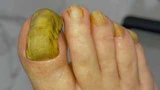 Huge ingrown toenail fungus treatment  Best video good healthy 01 [upl. by Ardnatal]