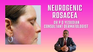 Neurogenic rosacea [upl. by Hogen]