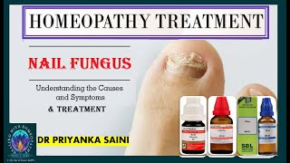 NAIL FUNGUS amp TOENAIL FUNGUS  HOMEOPATHY TREATMENT  INFECTONS SILICEA drpriyankashomeopathy [upl. by Ethban831]