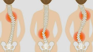 CÓMO CORREGIR LA LORDOSISCIFOSIS y ESCOLIOSIS en tu COLUMNA😉 [upl. by Haberman]
