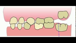 Early Mesial Shift Erken Mesial Shift [upl. by Suolkcin]