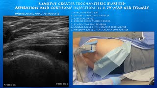 Ultrasound Guided Massive Greater Trochanteric Bursitis Aspiration and Injection by probeultrasound [upl. by Leoline]