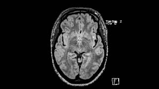 White matter disease associated with migraine headaches [upl. by Brandy]