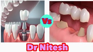 Dental Implant vs Bridge which one is better [upl. by Gaulin]