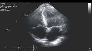 Amyloid Cardiomyopathy with Restrictive Filing [upl. by Peder904]