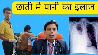 Pleural effusion treatment ll छाती मे पानी का इलाज ll Chest Specialist in patna ll Dr Sanjay kumar [upl. by Okomom]