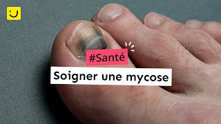 Soigner une mycose [upl. by Naols]