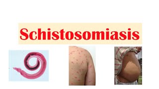 Schistosomiasis  Bilharziasis  Causes Symptoms and Treatment [upl. by Sicnarf]