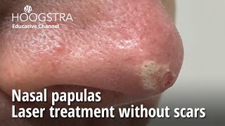 Nasal papulas  Laser treatment without scars  24129 [upl. by Noiramaj]