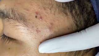 Blackheads amp Whiteheads Removal New On ForeHead 2024 Acne Treatment With Nhat Bang [upl. by Weismann936]