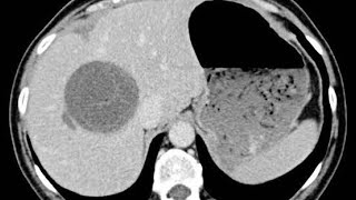 Why Liver Abscess is common on the right lobe [upl. by Thibaud]