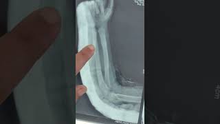 A greenstick fracture  fracture [upl. by Hsu566]