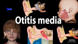 Otitis Media Anatomy Pathophysiology Risk Factors Types of OM Symptoms and Treatment Animation [upl. by Livvie]