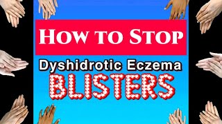 HOW I STOPPED DYSHIDROTIC ECZEMA AND BLISTERS FOR GOOD [upl. by Mauer]