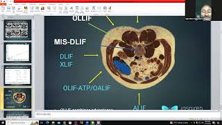 Inspired Spine July case conference  Post OLLIF Neuritis  risk factors presentation management [upl. by Claire388]