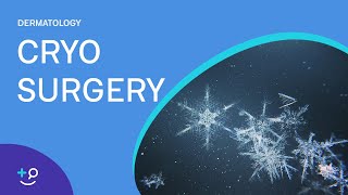 Cryo Surgery Procedure Freezing [upl. by Lacie]