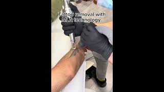 Tatueringsborttagning med Pico Laser Lutronic PicoPlus [upl. by Eednil422]