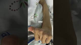 Cerebral palsy tremor of forearm wrist hand was stopped immediately [upl. by Yorgen391]