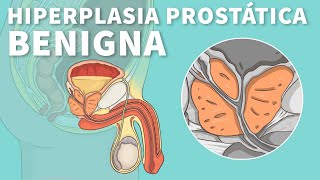 Hiperplasia prostática benigna Causas síntomas y tratamiento HPB  Stanford [upl. by Ronna590]