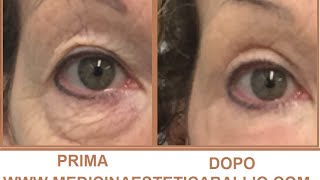 Blefaroplastica non chirurgica con Laser frazionato associato a PRP  Drssa Ballio [upl. by Ycniuqed]