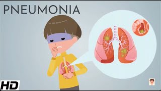 Pneumonia Everything You Need To Know [upl. by Irtimed687]