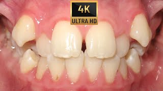 🤔HOW BRACES WORK Amazing TRANSFORMATION  four premolars extraction case❗Braces time lapse [upl. by Relyc]