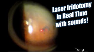 Laser Iridotomy in Real Time with Laser Sounds Chris Teng MD [upl. by Fagin299]