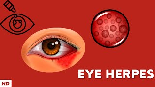 Eye Herpes Causes Signs and Symptoms Diagnosis and Treatment [upl. by Zetrok405]