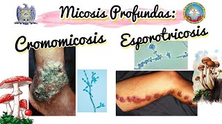 CROMOMICOSIS y ESPOROTRICOSIS explicación y CASO CLÍNICO 🍄 [upl. by Etnaud893]