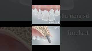 Dental bridge Vs Implant dental [upl. by Kress302]