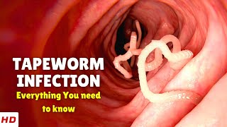 Tapeworm Infection – Causes Signs and Symptoms Diagnosis amp Treatment [upl. by Mintun]