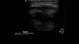 Knee Ultrasound Tibial Tubercle Avulsion Fracture [upl. by Opiak]