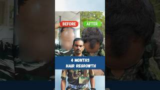 4 Months hair regrowth  Hair loss  Hair fall  Hair Damage viral shorts [upl. by Bender]