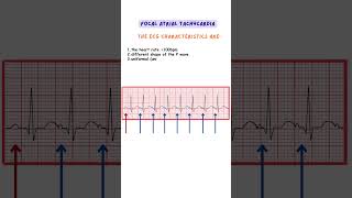 Focal Atrial Tachycardia ecg ecginterpretation medicine doctor nurse [upl. by Merril]