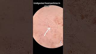 Undigested food particles in stool [upl. by Konopka784]