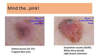 Dermatoscopic features of thin nodular melanoma  Dr Dimitris Sgouros [upl. by Auqenahc]