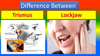 Difference Between Trismus and Lockjaw [upl. by Innos273]