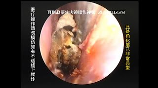 External auditory canal cholesteatoma with very narrow entrance 20240229 [upl. by Vallie]